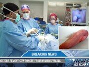 Doctors Remove Cow Tongue From Woman’s Vagina